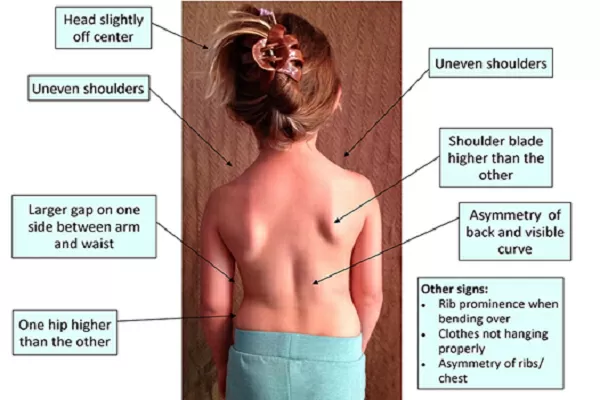 Chiropractic Phoenix AZ Child With Scoliosis