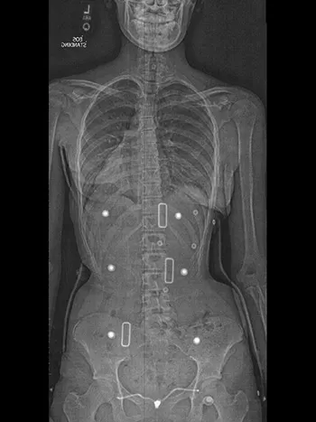Chiropractic Phoenix AZ Patient In Brace X-ray