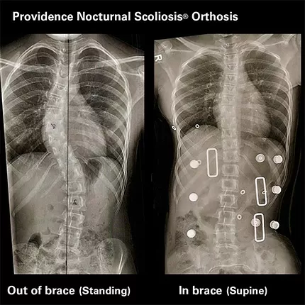 Chiropractic Phoenix AZ Providence Nighttime Scoliosis Brace X-Ray