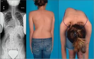 Chiropractic Phoenix AZ Scoliosis Diagram