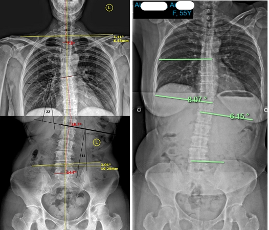 Chiropractic Phoenix AZ Scoliosis Results 14