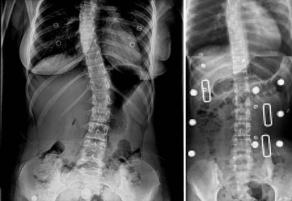 Chiropractic Phoenix AZ X-ray 2