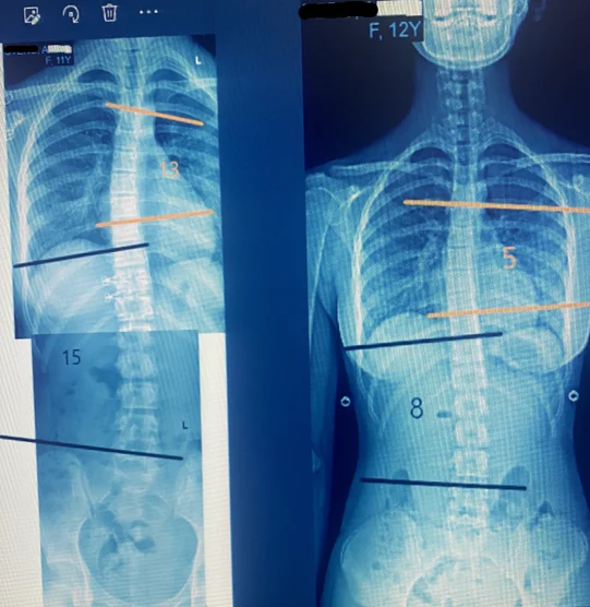 Chiropractic Phoenix AZ X-ray 3